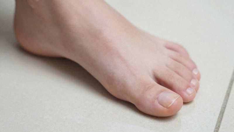 Jakie są objawy grzybicy paznokci?