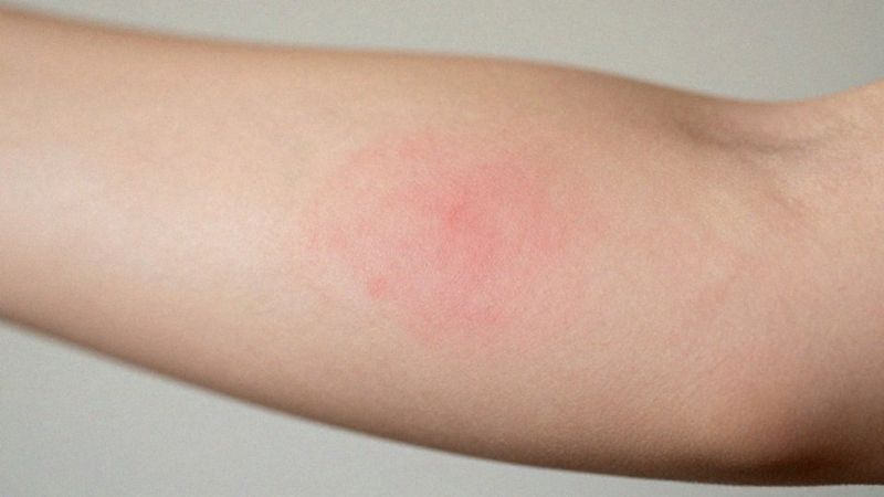 Jak rozpoznać objawy pokrzywki alergicznej?
