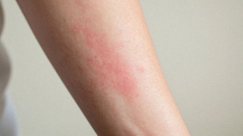 Jakie objawy sugerują uczulenie, a nie różyczkę?
