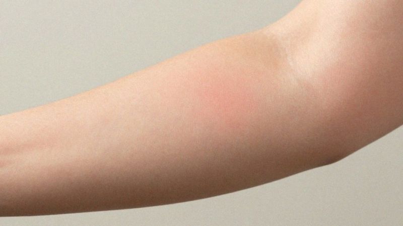 Jakie są objawy rumienia skóry?
