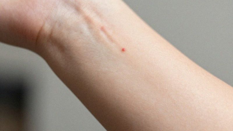 Czy ugryzienia od pluskiew powodują komplikacje?
