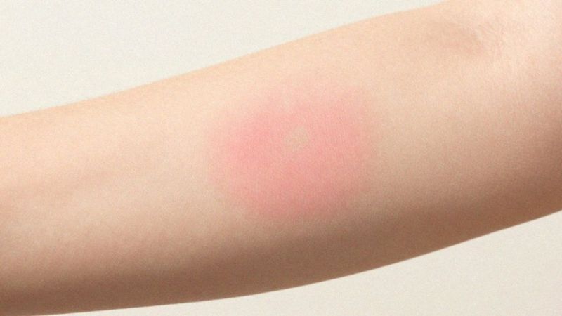 Jak rozpoznać bąble pokrzywkowe i rumień?