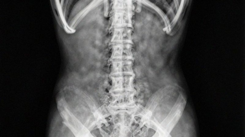 Jakie powikłania niesie niekorygowana zmiana krzywizny szyjnej?