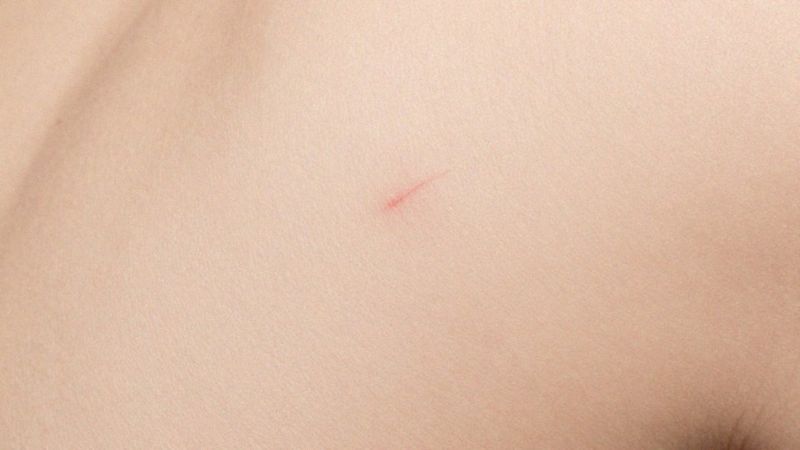 Czy drapanie zwiększa ryzyko infekcji skórnej?