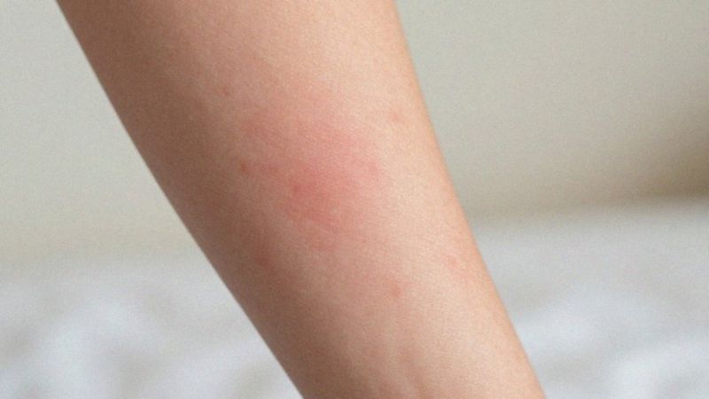 Jakie są kliniczne objawy nadwrażliwości typu 4?