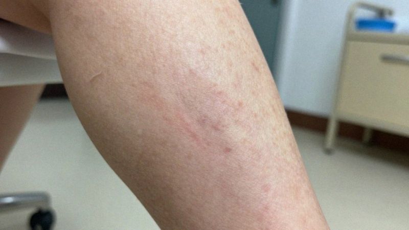 Jak niewydolność żylna prowadzi do owrzodzeń?