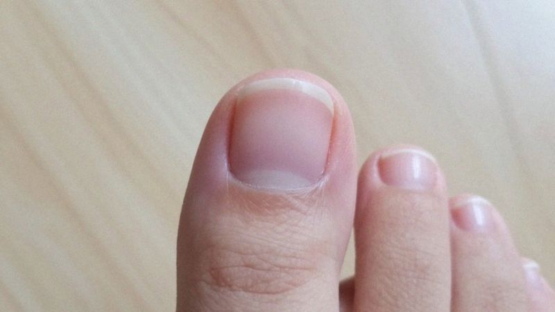 Jakie są najczęstsze przyczyny zgrubienia na paznokciu?