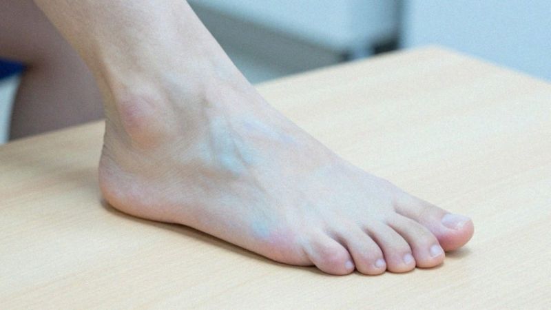 Jakie są objawy choroby Buergera w kończynach?