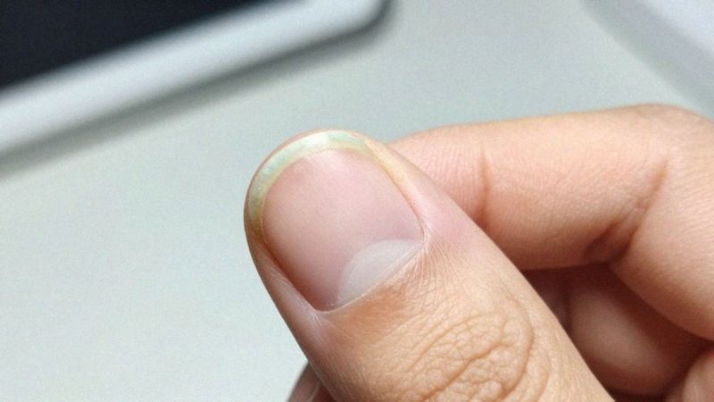 Jak zielona bakteria kolonizuje paznokieć i jak się diagnozuje?