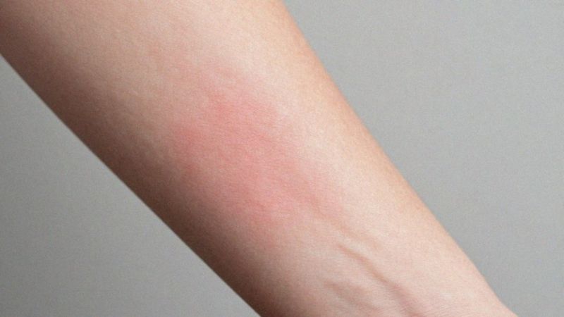 Jakie są objawy wyprysku kontaktowego niealergicznego?
