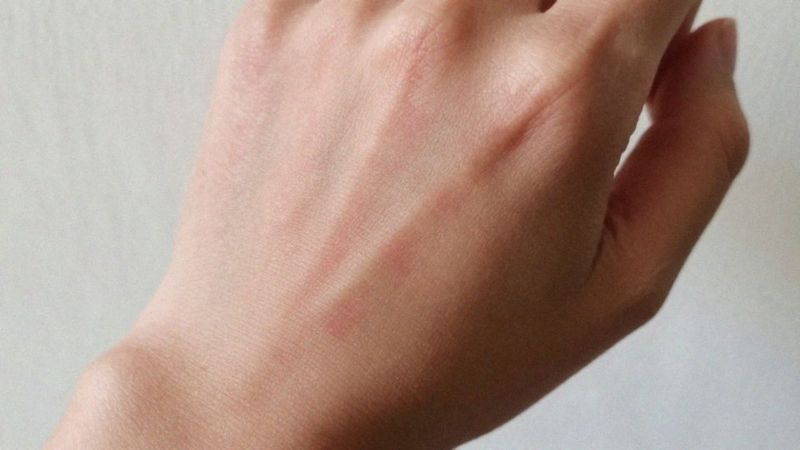 Jak objawia się niedobór kwasu linolowego?