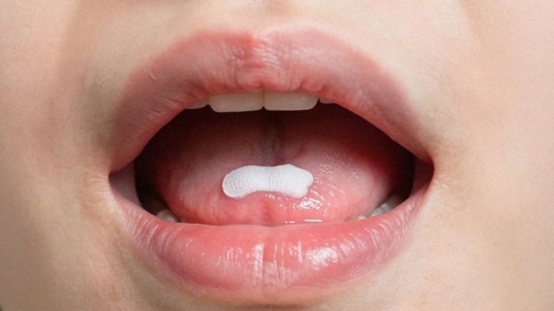 Jakie są objawy i typy leukoplakii?