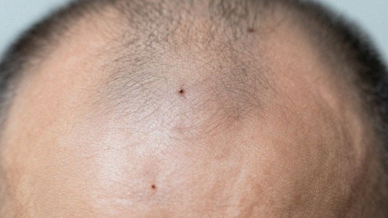 Jak mikrobiom i sebum wpływają na owłosioną skórę głowy?