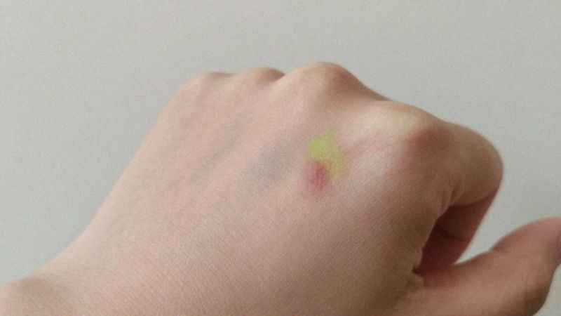 Jak wyglądają etapy gojenia siniaka?