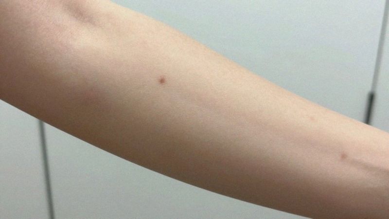 Jakie są objawy kliniczne zakażenia?