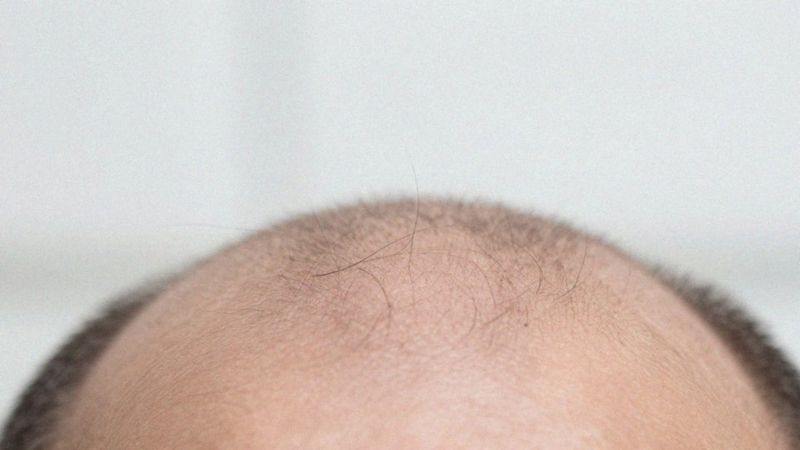 Jak Malassezia i sebum powodują łupież?