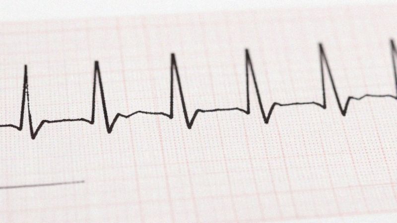 Jak rozpoznać pobudzenia przedwczesne w EKG?